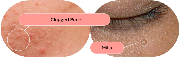 skin with clogged pores and skin with milia