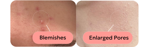 skin with blemishes and skin with enlarged pores