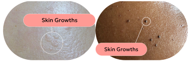 skin with skin growths