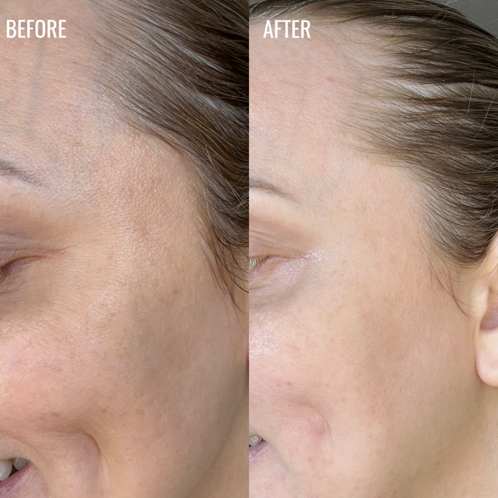 Crows-Feet-before-and-after-pic