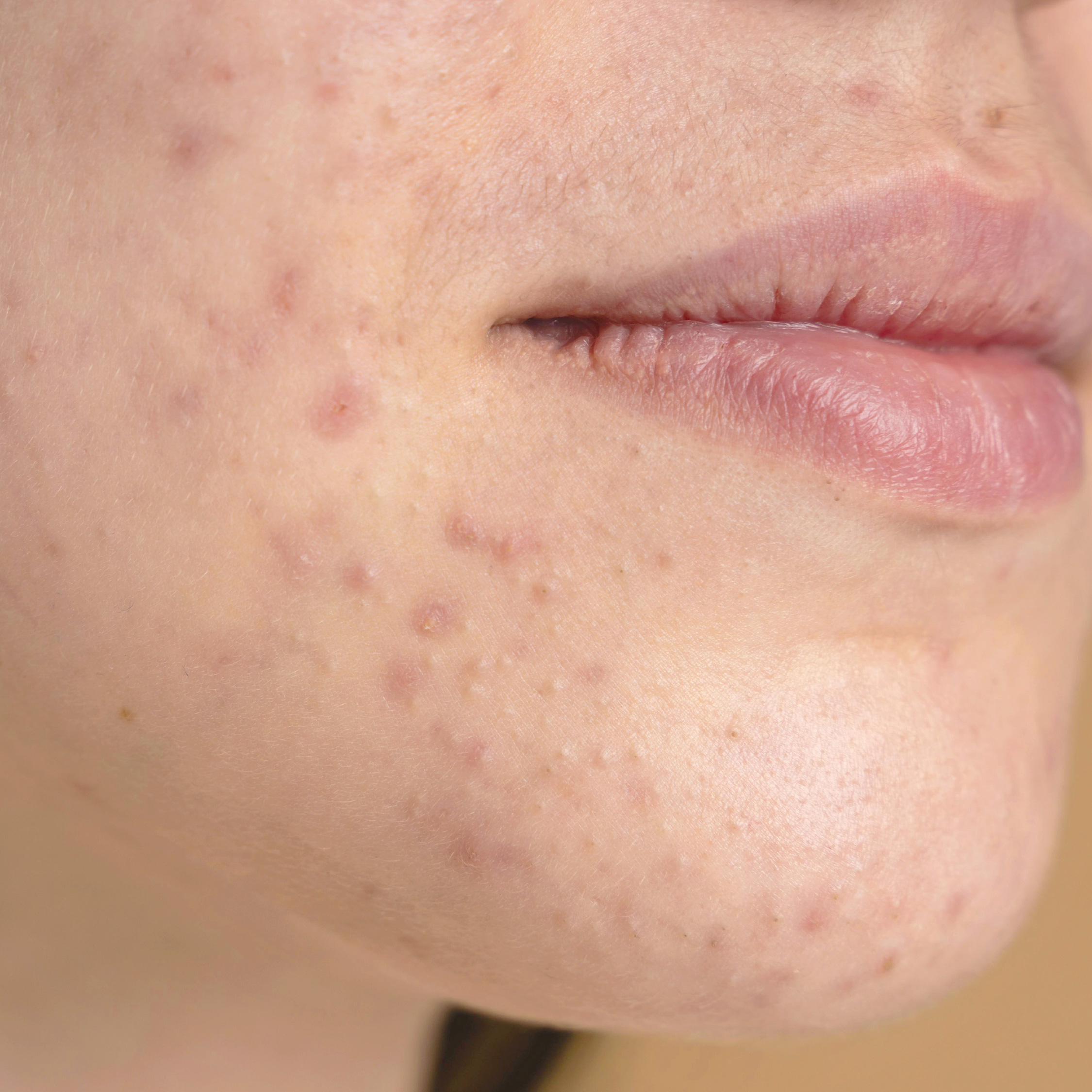 skin irritation