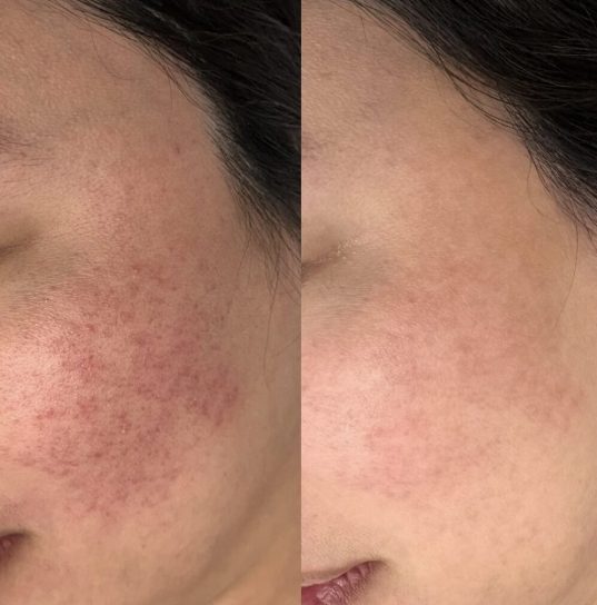 before and after skin photos of roseacea treatment
